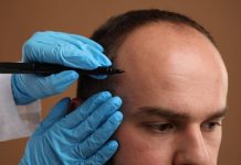 The reality of dealing with hair loss in Scotland