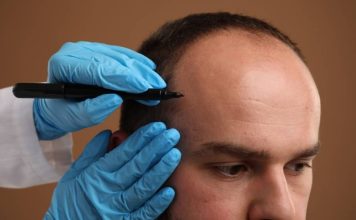 The reality of dealing with hair loss in Scotland